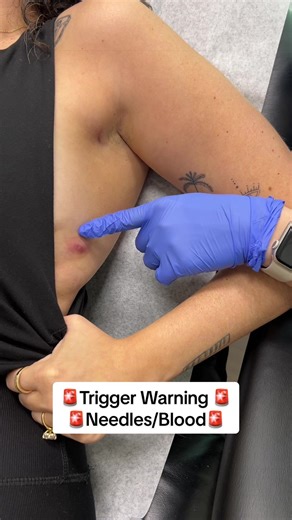 🚨Trigger warning: needles, injections, and blood. 🚨 Today’s dermatologist appointment was for a one-off cyst that has nothing to do with my HS. Sometimes these things just happen. The injections definitely suck in the moment, but I’ve learned that a few minutes of pain or discomfort is worth it when I know relief is right around the corner. Living in a body with chronic illness means constantly weighing what will help in the long run. For me, I’ll take the quick injection every time if it mean