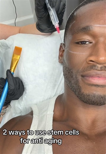 I’m not in the business to change my face or try to look younger than my age. I just like looking the best I can. Our body sees stem cells as its own building blocks, that carries signals to tissues that need to be repaired… Natural regeneration 🧬 - Microneedling done @Boundlessvitalitymiami / Stem cell injection done R3 Health in West Palm Beach #stemcellinjection #microneedling #antiaging #hyperpigmentationtreatment #aesthetictreatments