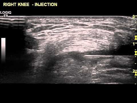 Ultrasound guided Injection of the Suprapatellar pouch Knee -Dr Peter Resteghini