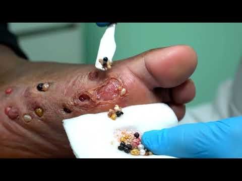 JIGGER REMOVAL Therapy 😱 Dirty Foot Deep Cleaning 🔥 #ASRM 3