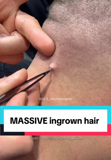 Massive Ingrown Hair Extraction Explained by Doctor