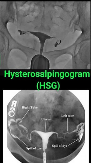 Hysterosalpingography (HSG) # bilateral tubal spillage seen in HSG # fallopian tube patency test