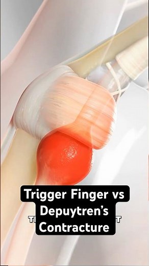 Why Your Finger Might Be Stuck (and How to Fix It)