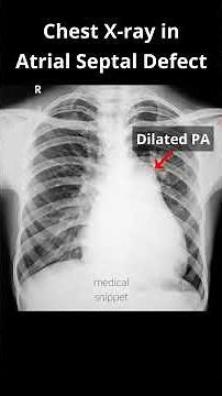 Chest Xray (Part 2) in Atrial septal defect (ASD) #shorts #asd #cxr