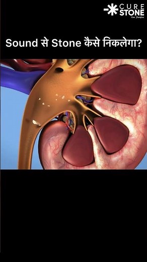 How does sound waves remove kidney stones #urology