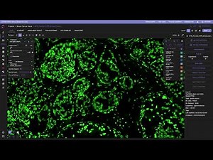 10x Genomics Atera Human Breast Cancer Dataset: Interactive Analysis with C-DIAM Multi-omics Studio