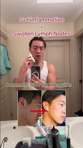 Why do i get Swollen lymph nodes around the jawline and acne ? . Both can indeed be linked to poor
