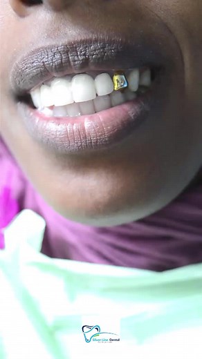 Get a Permanent Gold Cap at Silverline Dental Clinic in Eastleigh