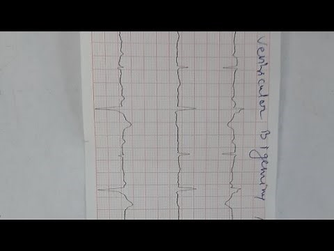 ventricular bigeminy and trigeminy