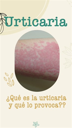 ⚠️​𝐔𝐑𝐓𝐈𝐂𝐀𝐑𝐈𝐀⚠️​ La urticaria, también conocida como sarpullido o habones, es una reacción cutánea que causa ronchas con picazón en la piel. Estas ronchas pueden variar en tamaño y forma, y suelen aparecer y desaparecer repentinamente en cualquier parte del cuerpo. 👉​ La urticaria puede ser desencadenada por diversas causas, incluyendo: ✅​Alergias: Reacciones alérgicas a alimentos, medicamentos, picaduras de insectos, etc. ✅​Factores físicos: Calor, frío, luz solar, agua, presión y ejer