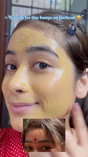 How to remove tiny bumps from forehead 🍀 #journeywithgauri #skincare #brightskin #glowup