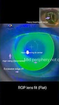 Flat fitted RGP contact lens characteristics