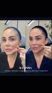 Sculptra ofrece varios beneficios en tratamientos estéticos, especialmente para el rostro. Aquí te enumero los principales beneficios de Sculptra: 1. Estimulación del Colágeno: Sculptra estimula la producción natural de colágeno en la piel, lo que ayuda a restaurar el volumen y mejorar la elasticidad de la piel con el tiempo. 2. Resultados Naturales: A diferencia de otros rellenos dérmicos, Sculptra proporciona un efecto gradual. Esto permite que los resultados se vean más naturales, ya que el v