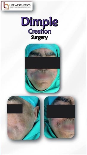 54-Year-Old Patient from Dubai Gets Dimple Creation Surgery | Dr. Ashwini Dash