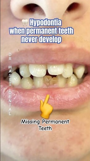 🦷 Hypodontia – when permanent teeth never develop.