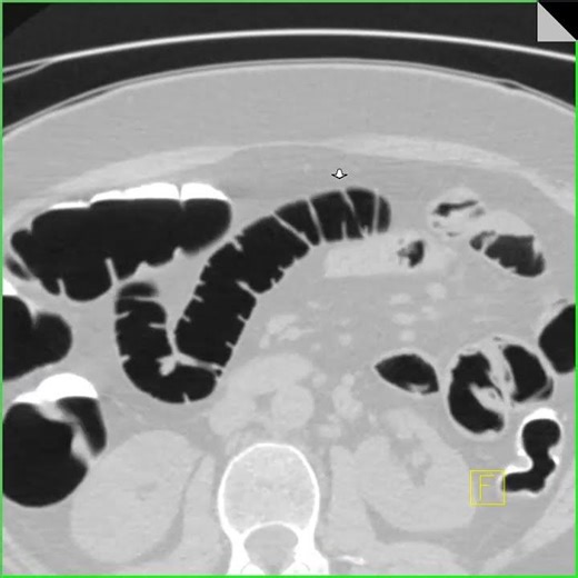 Virtual colonoscopy with prone imaging