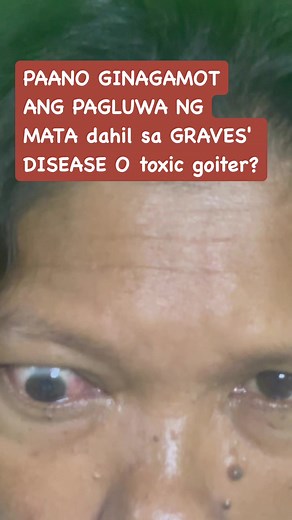 PAANO GINAGAMOT ANG GRAVES' OPHTHALMOPATHY o ang pagluwa ng mata dahil sa toxic goiter? Maraming paraan depende kung gaano kalala ang iyong kalagayan!😀. Ang pagbibigay ng steroids, selenium o may mga bagong gamot ngayon tulad ng teprotumumab 😍 , orbital decompression surgery at orbital surgery ang ilan sa mga gamutan na pwedeng ibigay depende sa lagay na mata. 😀 #thyroidhealth #thyroid #goiter #gravesdisease #docirma | Irma Antonio-Pilar MD/ Diabetes and Thyroid Specialist