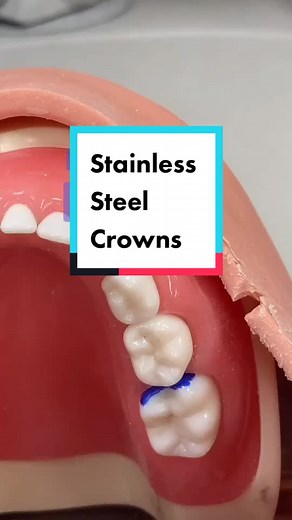 How to Crown a Tooth with Stainless Steel Crowns in Children