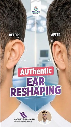 क्या कानों की Shape बदली जा सकती है? See Otoplasty Before & After