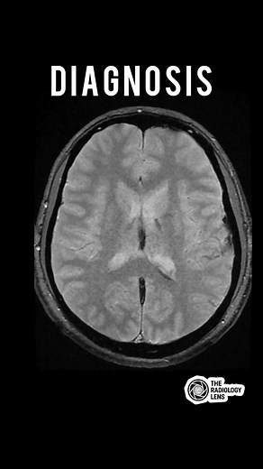 Diagnosis⬇️ #NeuroImaging #RadiologyCases #MedicalImaging #TheRadiologyLens | The Radiology Lens