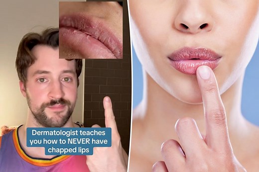 Dermatologist’s 3 steps to never have chapped lips again — just toss, drop and smear