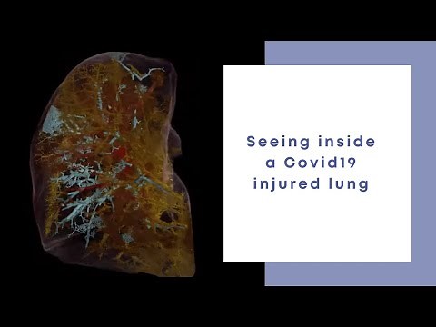 SEEING INSIDE A COVID19 INJURED LUNG