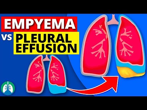 Empyema vs. Pleural Effusion *EXPLAINED*