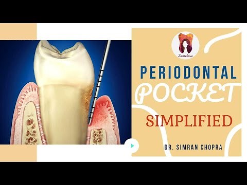 Periodontal Pocket-SIMPLIFIED!
