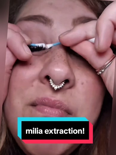 Effective Milia Extraction with the Beauty Pen