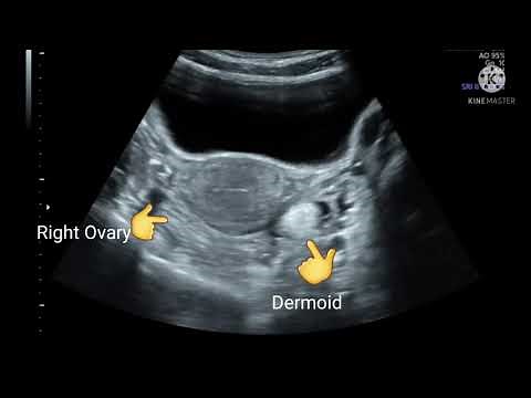 Left ovarian dermoid cyst