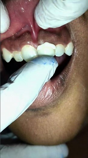 fix teeth cap fiting #dentist