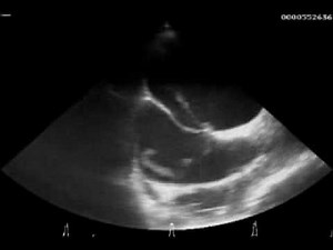 Thrombus in a Patent Foramen Ovale