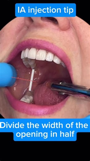 Dr adhya thakur arora on Instagram: "🦷 Inferior Alveolar Nerve (IAN) 🔹 Origin: Branch of mandibular nerve (V3) – Trigeminal nerve 🔹 Course: Infratemporal fossa → enters mandibular foramen → runs in mandibular canal → exits as mental nerve 🔹 Supplies: ✅ Mandibular teeth (incisors to molars) ✅ Body of mandible ✅ Lower lip & chin (via mental nerve) 🔹 Branches: • Dental branches to teeth • Incisive nerve • Mental nerve 🔹 Clinical Importance: 💉 Inferior Alveolar Nerve Block (IANB) Used for ext