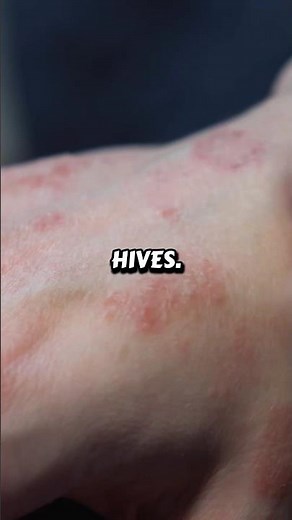 What Happens During an Allergic Reaction?