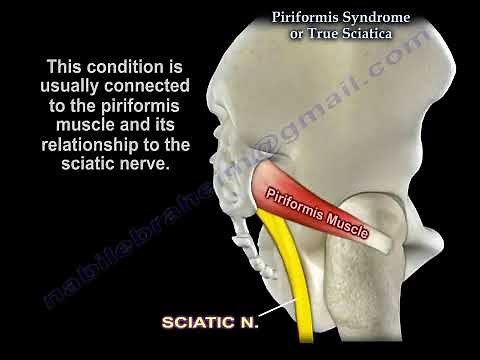 Piriformis Syndrome vs. Sciatica: Identifying the Actual Cause of Nerve irritation and Pain