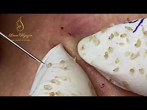Blackheads extraction (342) | Loan Nguyen