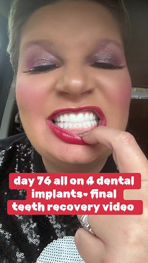 Day 76 All on 4 Dental Implants: Final Teeth Recovery Journey