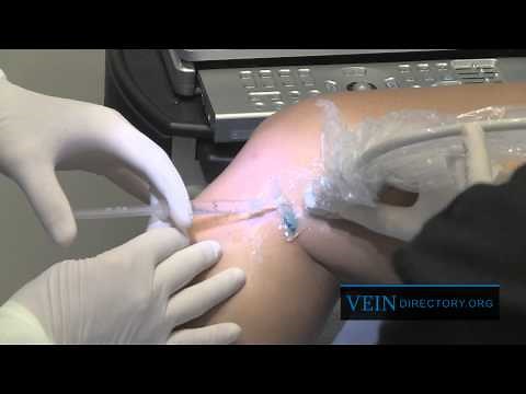 Endovenous Ablation: Outpatient Treatment for Varicose Veins