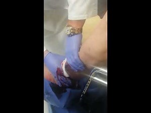 watch as a large blood clot is taken out of a hematoma on the leg.