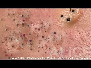 How to Get Rid Blackheads And Whiteheads On Face Easy Remedies