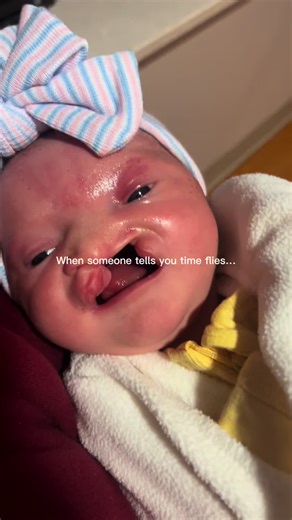 Embracing the Journey: Cleft Lip Awareness