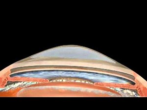 Z-LASIK Femtosecond Laser Procedure