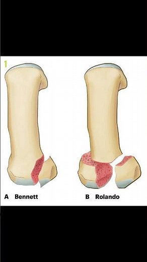 Bennett Fracture Explained 🦴💪 | Thumb Base Injury #orthopedic #ATC #meded #physiotherapy #handpain