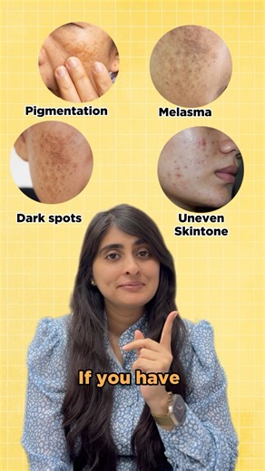 Skincare for Pigmentation and Uneven Skintone | Sunscreen for Pigmented skin | Dark Spots, Melasma
