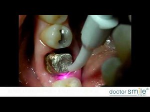 Doctor Smile Dental Laser Diode Surgery