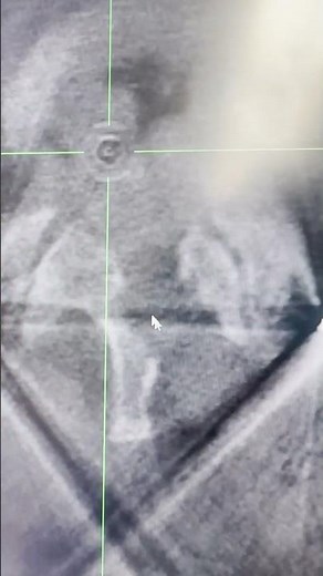 Laminectomy Surgery: From Navigated Spine Surgery to Examining X-Rays