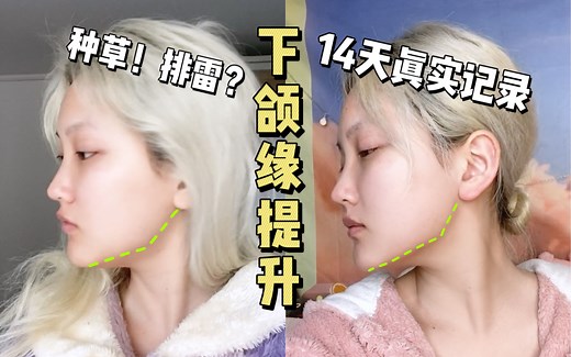 【圆子】超高性价比医美项目！瘦脸针科普|蛙腮现象|下颌缘提升