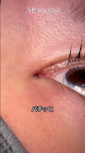 抜糸って痛い？麻酔できる？