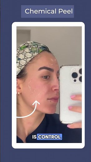 What Chemical Peels Actually Do To Your Skin