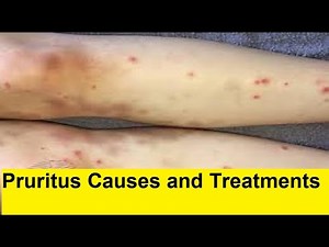 Pruritus Causes and Treatments